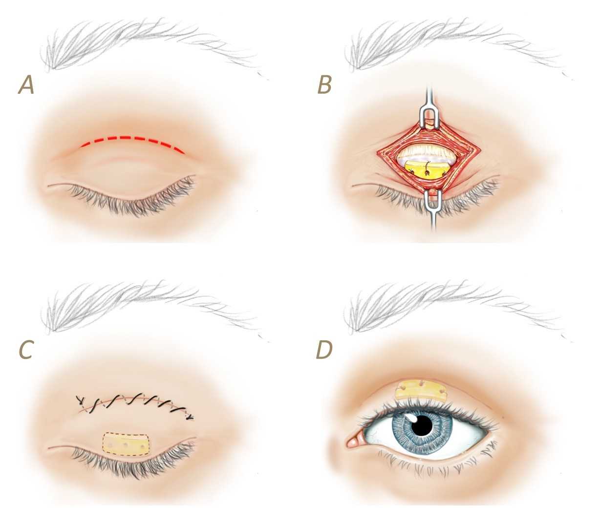 How Does Facial Paralysis & Bell's Palsy Affect The Eyes?