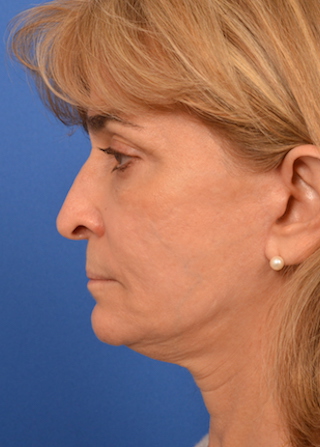 woman after elective neurolysis with facial rejuvenation