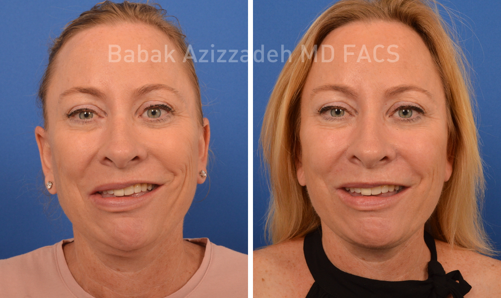 What to Expect from a Facial Paralysis Consultation