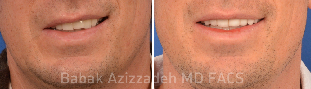 male patient before and after facial paralysis synkinesis treatment