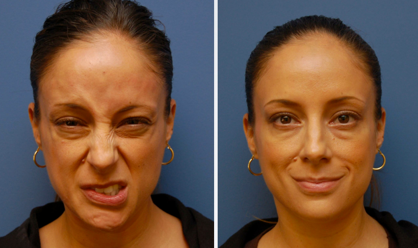 Exercises for Bell’s Palsy