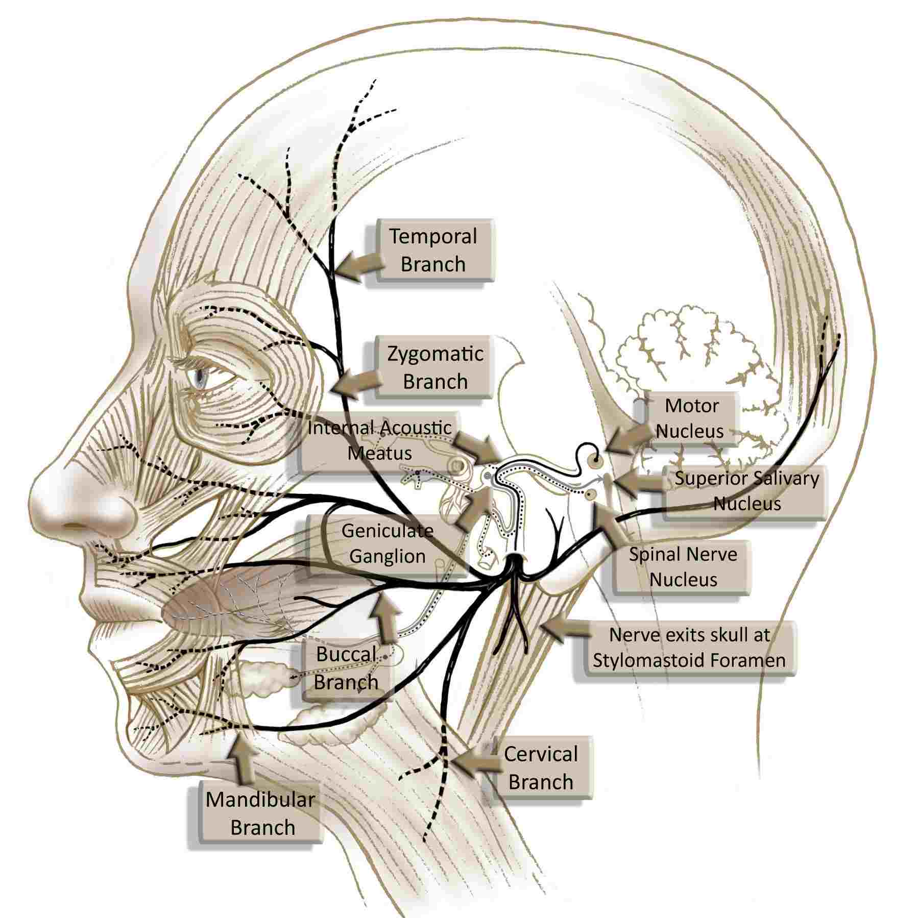 Hypoglossal-gracilis free flap 