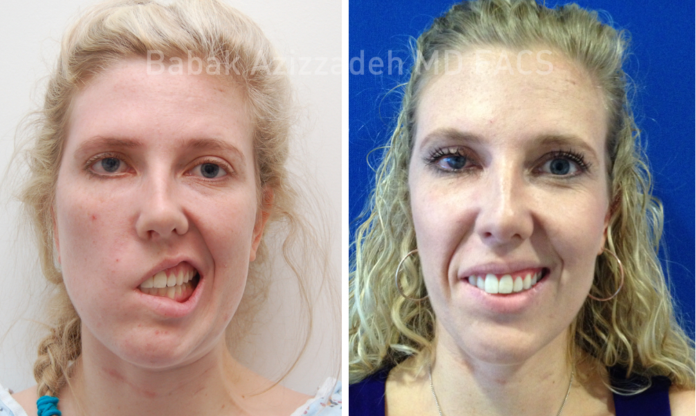 Masseter to Trigeminal Facial Nerve Transfer - Dr. Azizzadeh | FPI