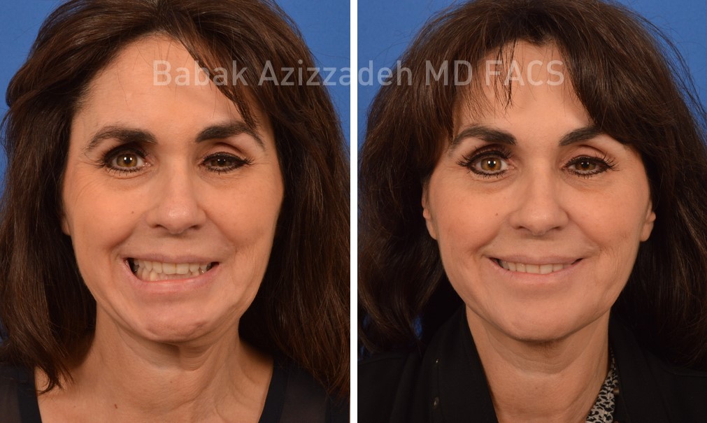 The Best Treatment For Bell's Palsy