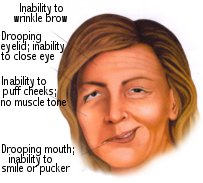 Treating Bell's Palsy 