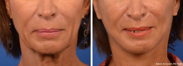 middle age woman befor and 1 year after bell's palsy treatment