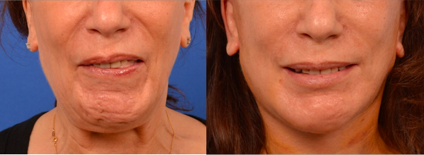 woman befor and 1 year after bell's palsy treatment
