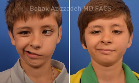 Surgical Options for Children with Facial Paralysis