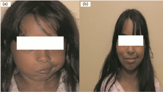 a female patient before and after cross-facial nerve graft