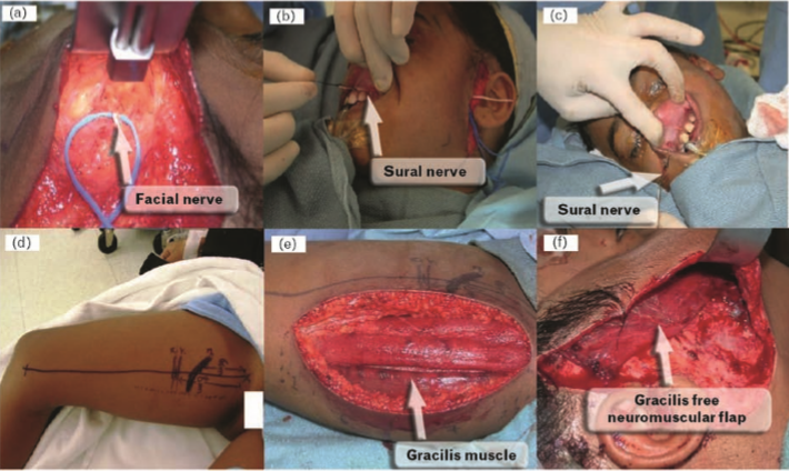 Cross-facial nerve graft procedure