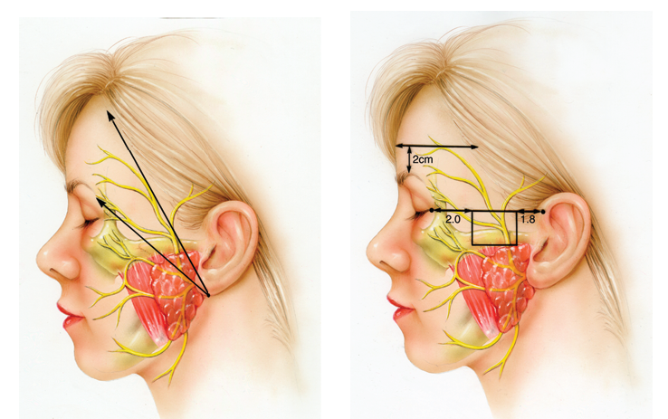 Causes of Facial Paralysis Hemifacial Microsomia 