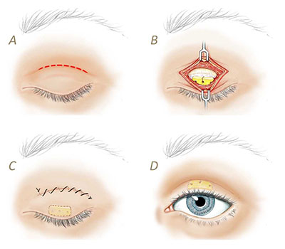 gold-eyelid-weights