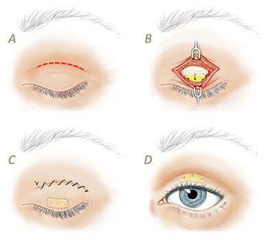 LIDS BY DESIGN: Get Instant Eyelid Lift Without Surgery by Britain