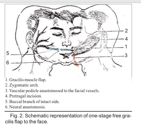Schematic representation of one-stage free gracilis flap to the face