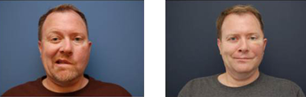 Patient with left-sided facial nerve paralysis before and after