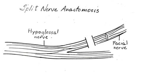 Splitting of the hypoglossal nerve