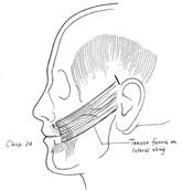 Placement of a static sling from the oral commissure to the temporal region.