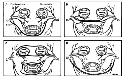 Variety of techniques for faciofacial cross-face graft.