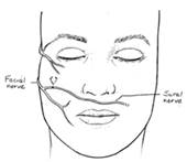 Two stage procedure of CFNG and free muscle graft