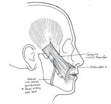 Gracilis muscle transfer with anastomosis of the obturator nerve to the CFNG and the adductor artery and vein to the facial artery and vein.