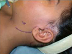 Proposed facelift incision and identification of the peripheral facial nerve on the unaffected side.