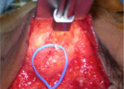 Elevation of the deep subcutaneous plane