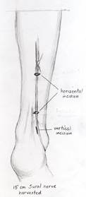 Harvest of approximately 15cm of the sural nerve, which is located approximately 1cm posterior to the lateral malleolus.