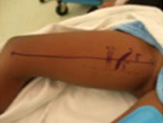 dentification of the obturator nerve and adductor artery and vein.
