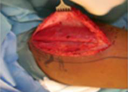 Harvest of a portion of the gracilis muscle with the adductor artery and vein and obturator nerve for anastomosis