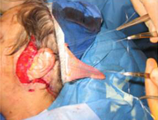 Sling material is secured to the oral commissure and nasolabial fold.