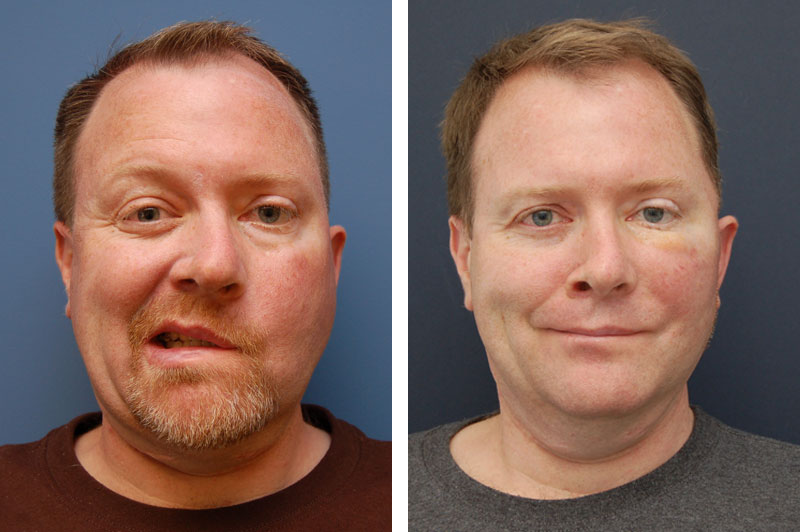 Exercises for Bell's Palsy