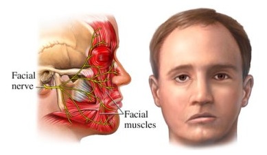 TV Reporter Develops Bell’s Palsy