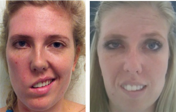 Revolutionary Facial Paralysis Treatments Offered At The Facial Paralysis Institute