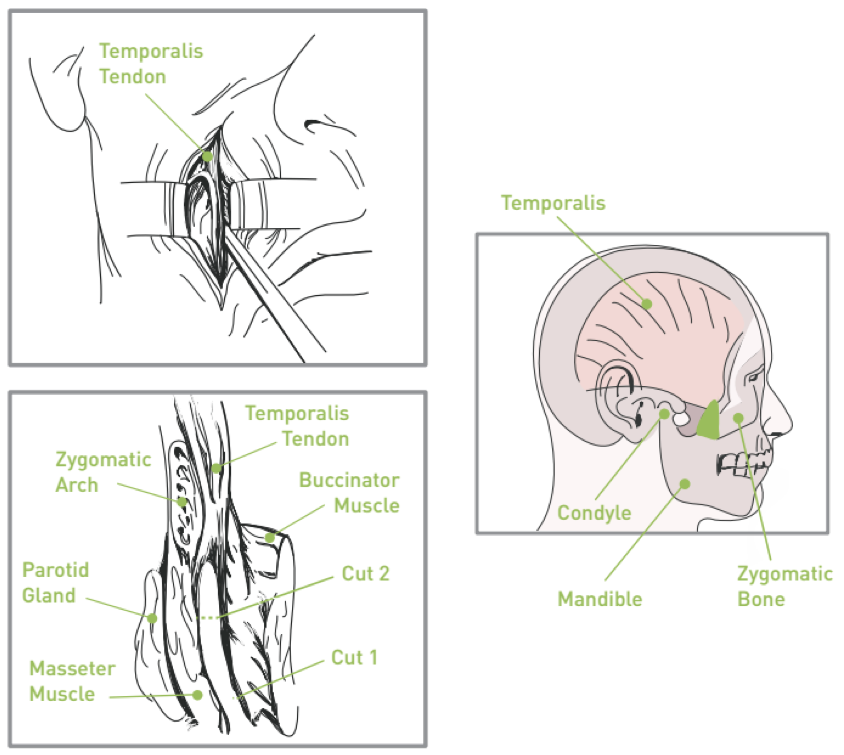 Temporalis Tendon Transfer