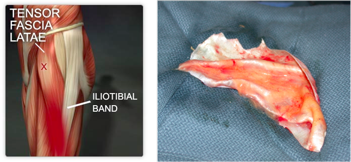 Tensor Fascia Latae