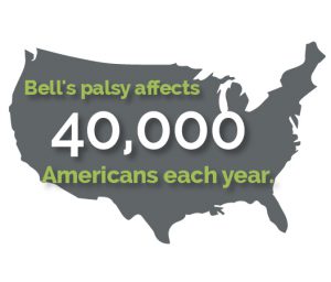 Selective Neurolysis for Bell's Palsy