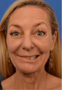 Selective neurolysis, facial rejuvenation and lower blepharoplasty before Watermarked