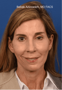 Selective neurolysis with asymmetric facelift 7 After Watermarked