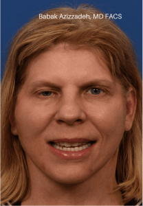 Selective neurolysis with asymmetric facelift After watermarked