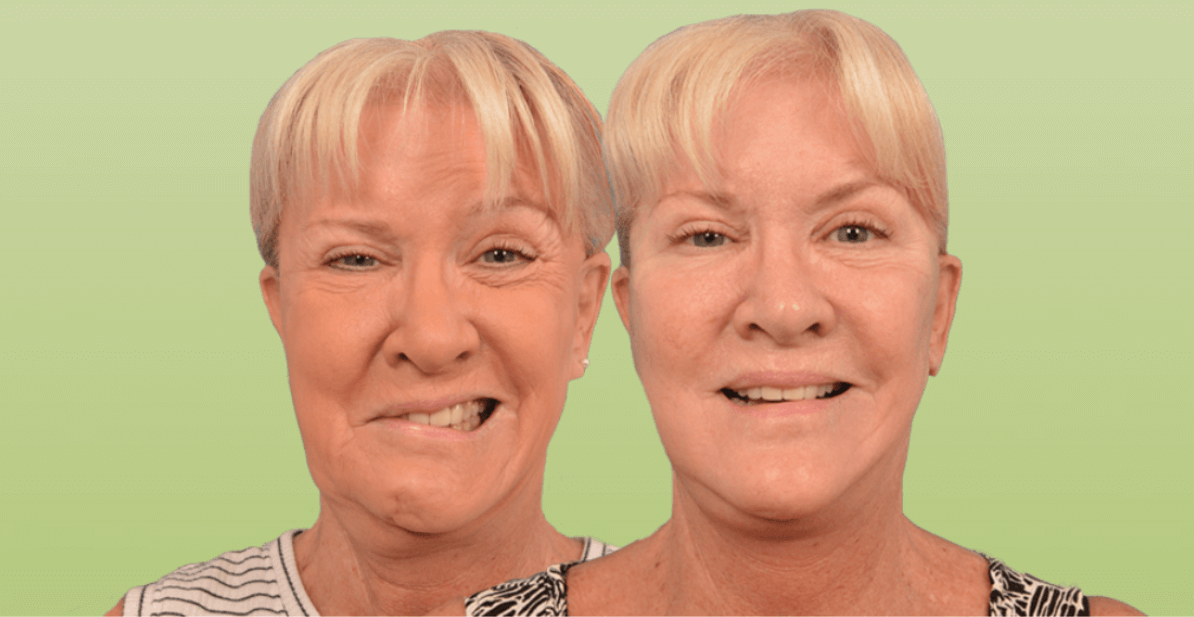 Before and after image of a woman with facial paralysis